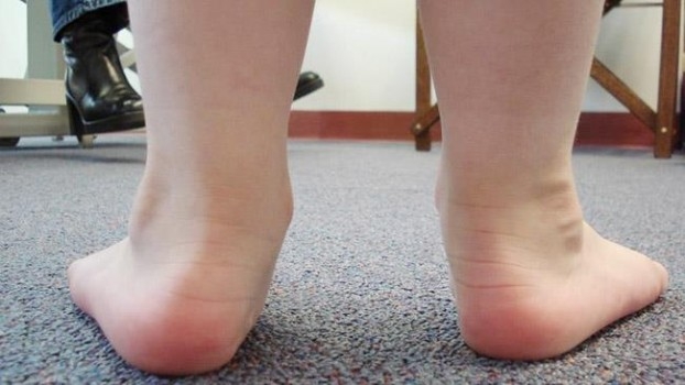 scarpe ortopediche per piedi piatti